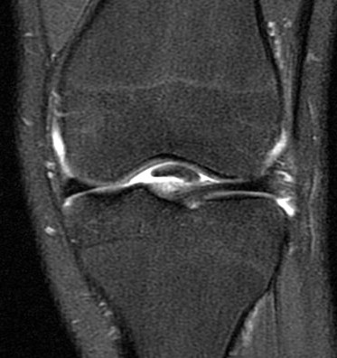 Figure 3 for case Unstable displaced lateral meniscus flap tear( RID2763 )